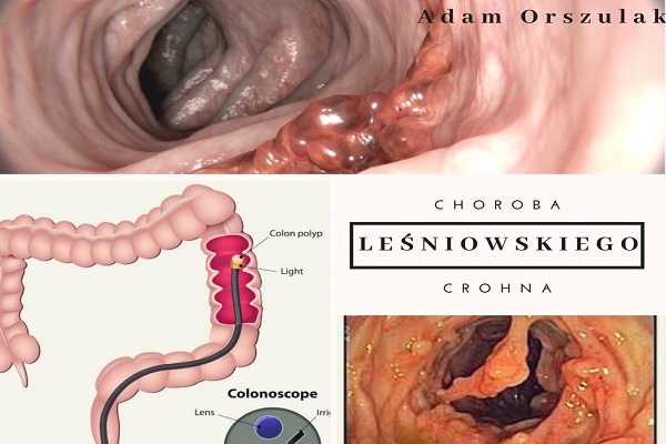 Choroba Leśniewskiego - Crohna