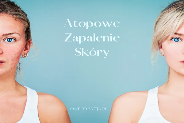 Atopowe zapalenie skóry Atopowe zapalenie skóry