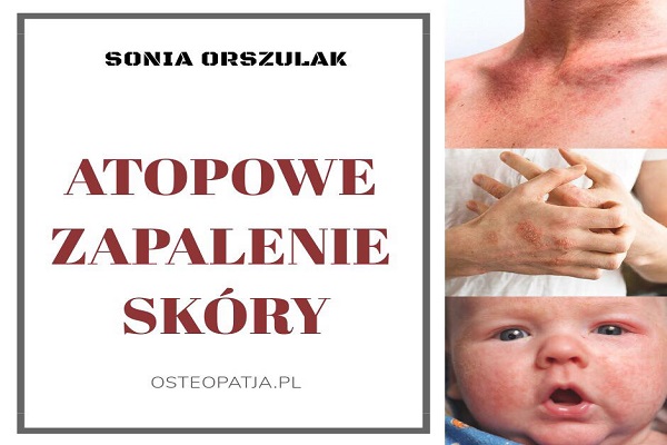 Dietetyka - Atopowe Zapalenie Skóry