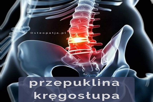 Przepuklina kręgosłupa