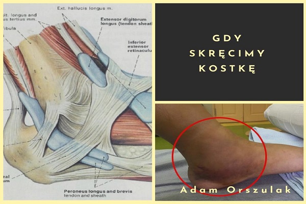 Skręcenie kostki