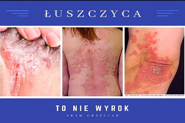 Łuszczyca Łuszczyca