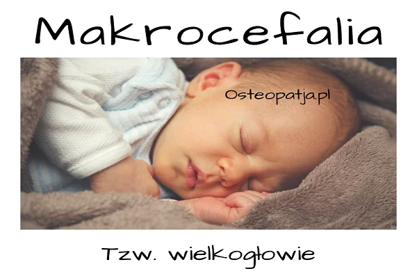 Makrocefalia