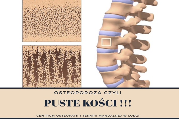 Osteoporoza Osteoporoza