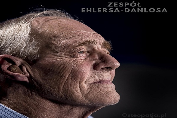 Zespół Ehlersa-Danlosa